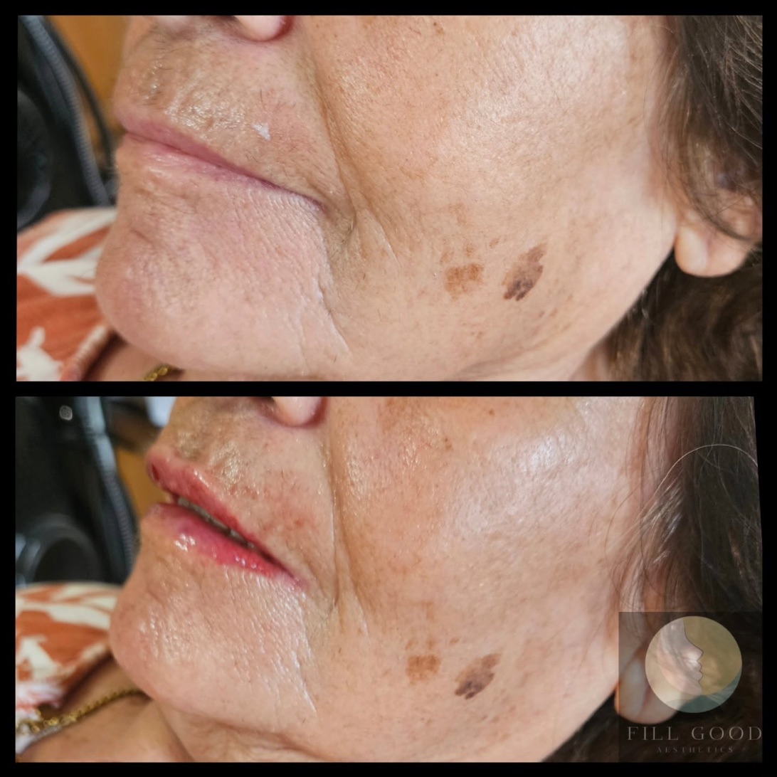 Before and after lip filler: the lower face in three-quarter view, before above and after below.