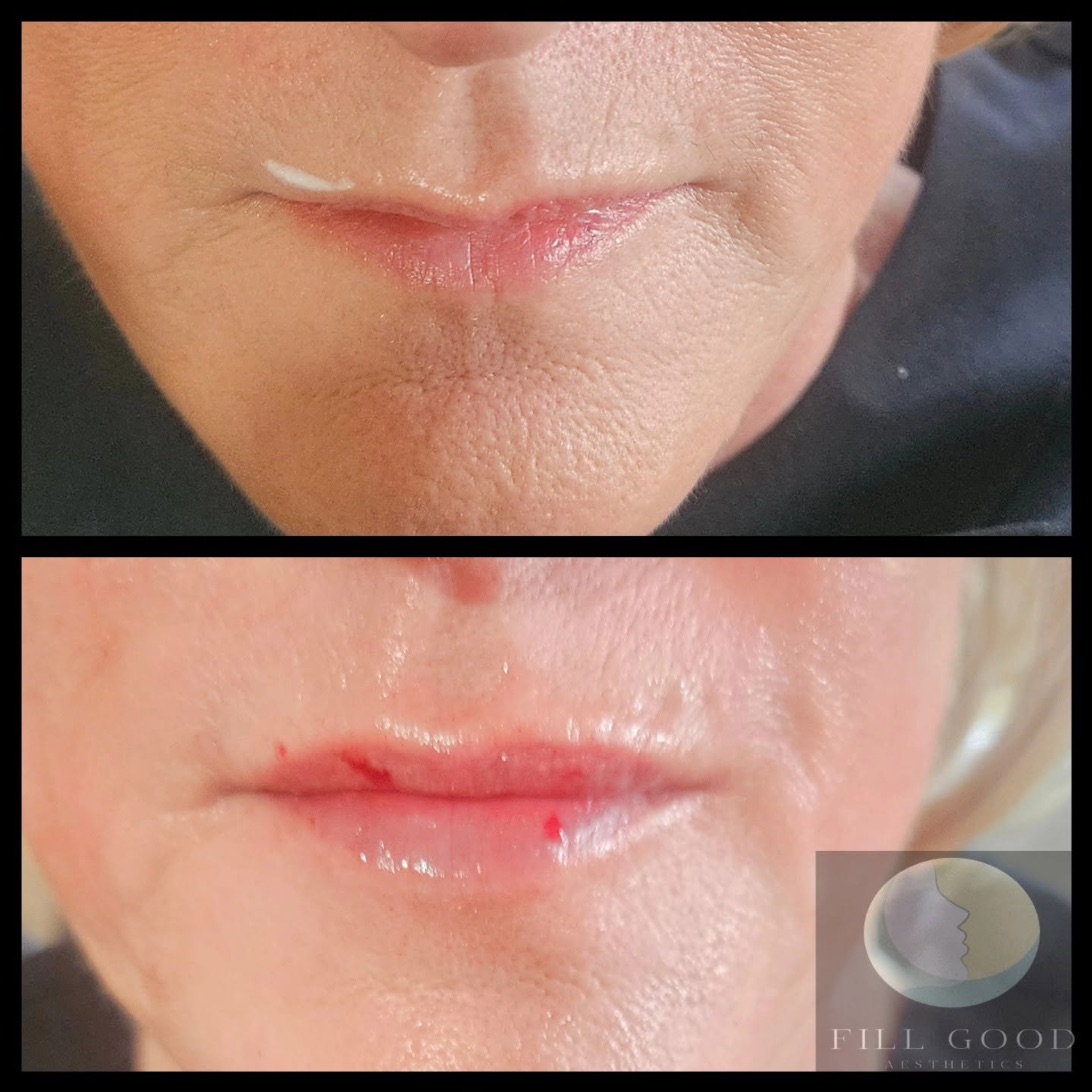 Before and after lip filler: the mouth front on, before above and after below. The after photograph shows small red marks on the lips.