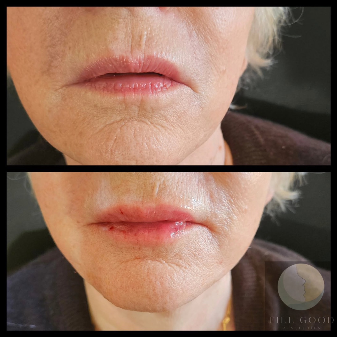 Before and after lip filler: the mouth and chin front on, before above and after below. The after photograph shows small red marks on the lips.