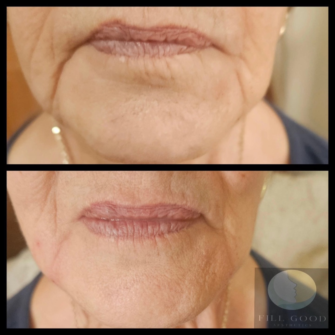 Before and after dermal filler: the mouth and chin front on, before above and after below.