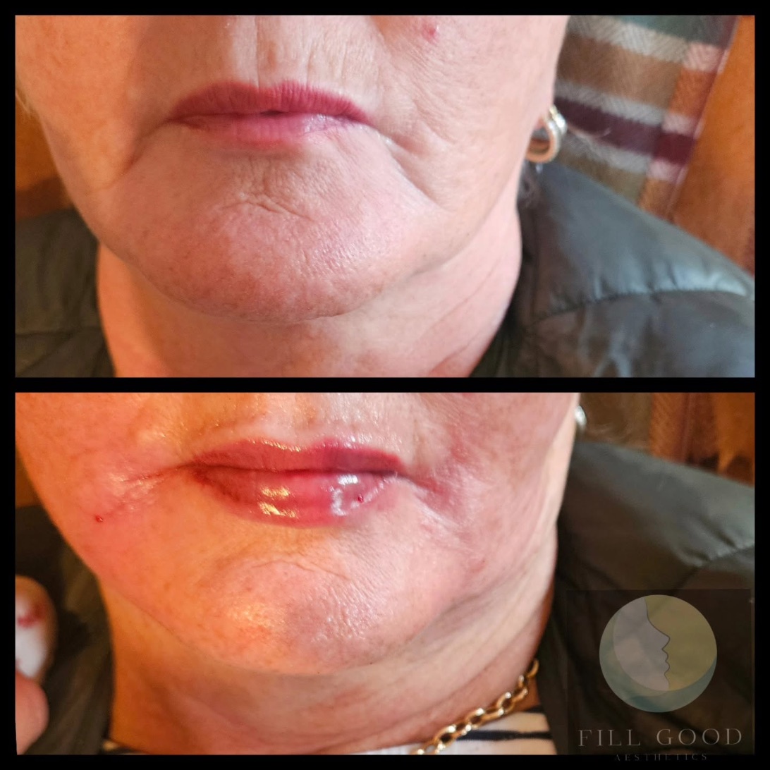 Before and after dermal filler: the mouth and chin front on, before above and after below. The after photograph shows small red marks around the mouth.