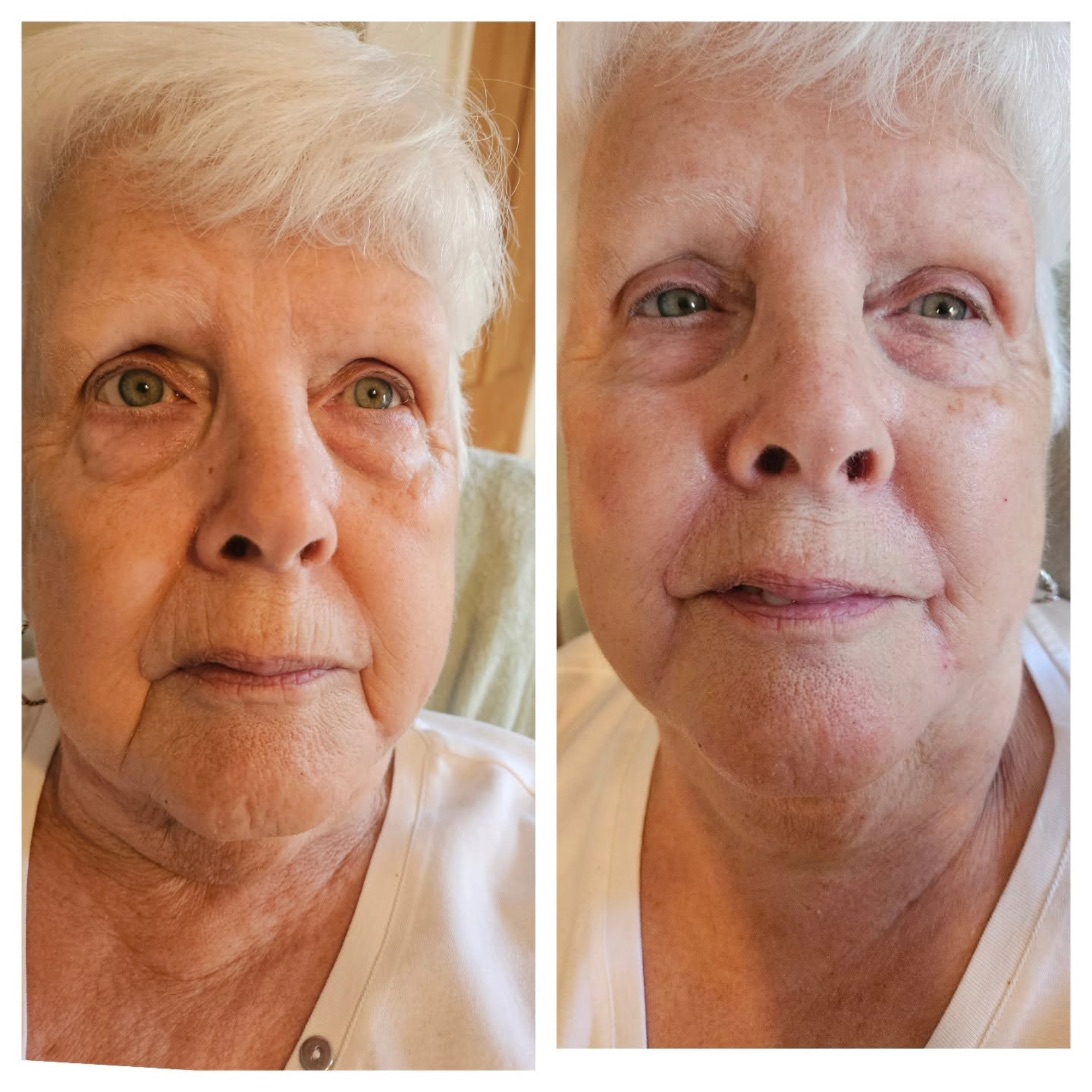 Before and after dermal filler: the whole face front on, before on the left and after on the right.