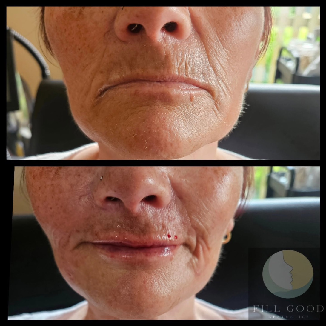 Before and after dermal filler: the lower face front on, before above and after below. The after photograph shows small red marks above the lip.