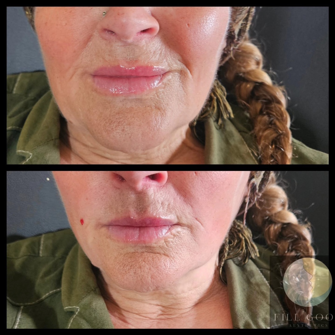 Before and after dermal filler: the lower face front on, before above and after below. The after photograph shows a small red mark beside the mouth.