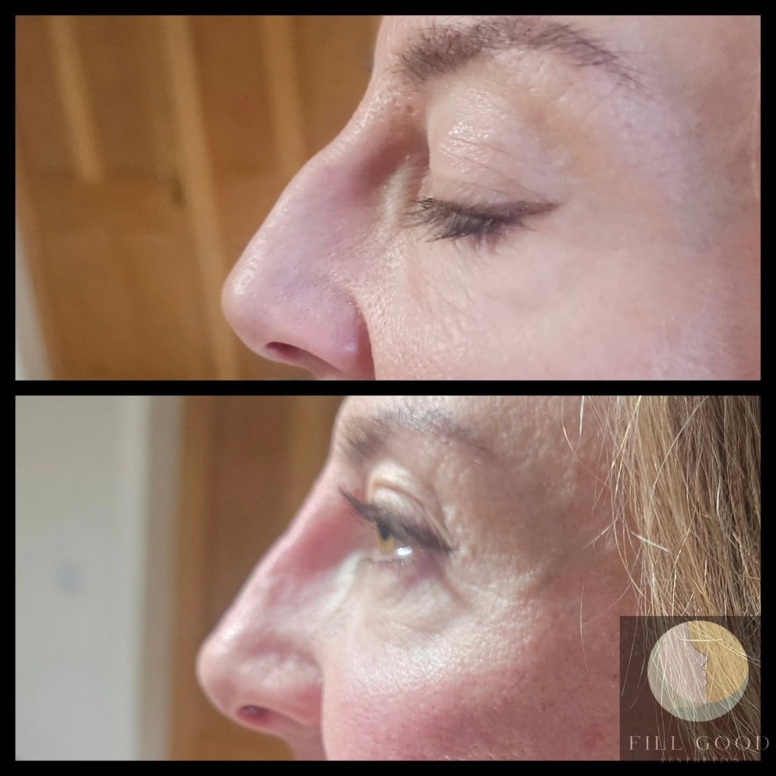 Before and after non-surgical nose reshaping: the nose in side profile, before above and after below.