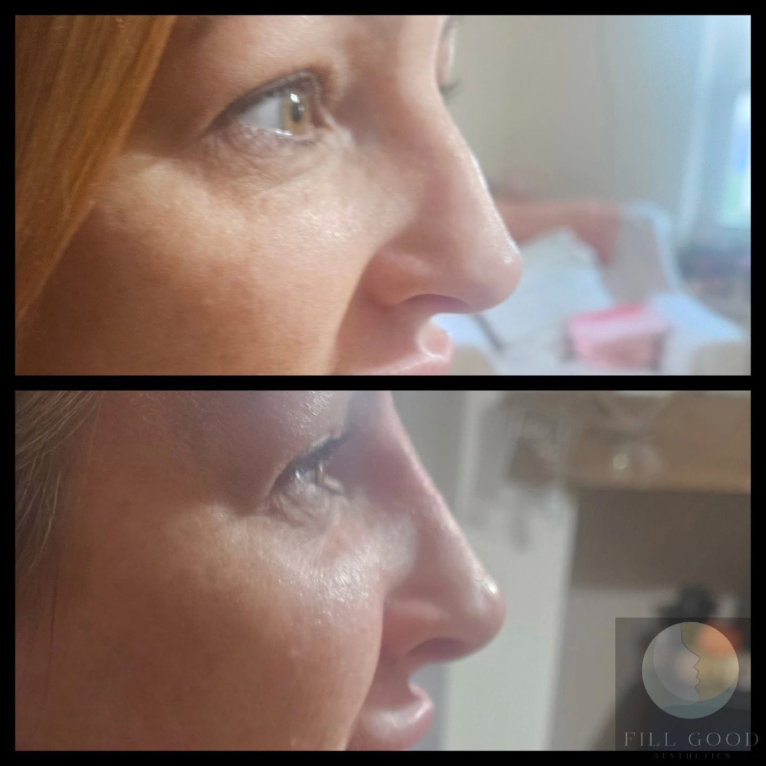Before and after non-surgical nose reshaping: the nose and eye in side profile, before above and after below.