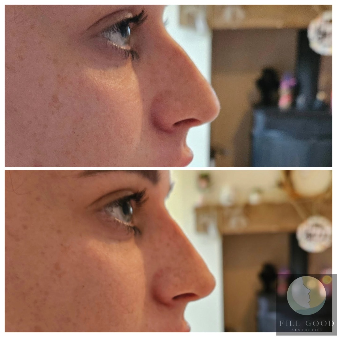 Before and after non-surgical nose reshaping: the nose in side profile, before above and after below.