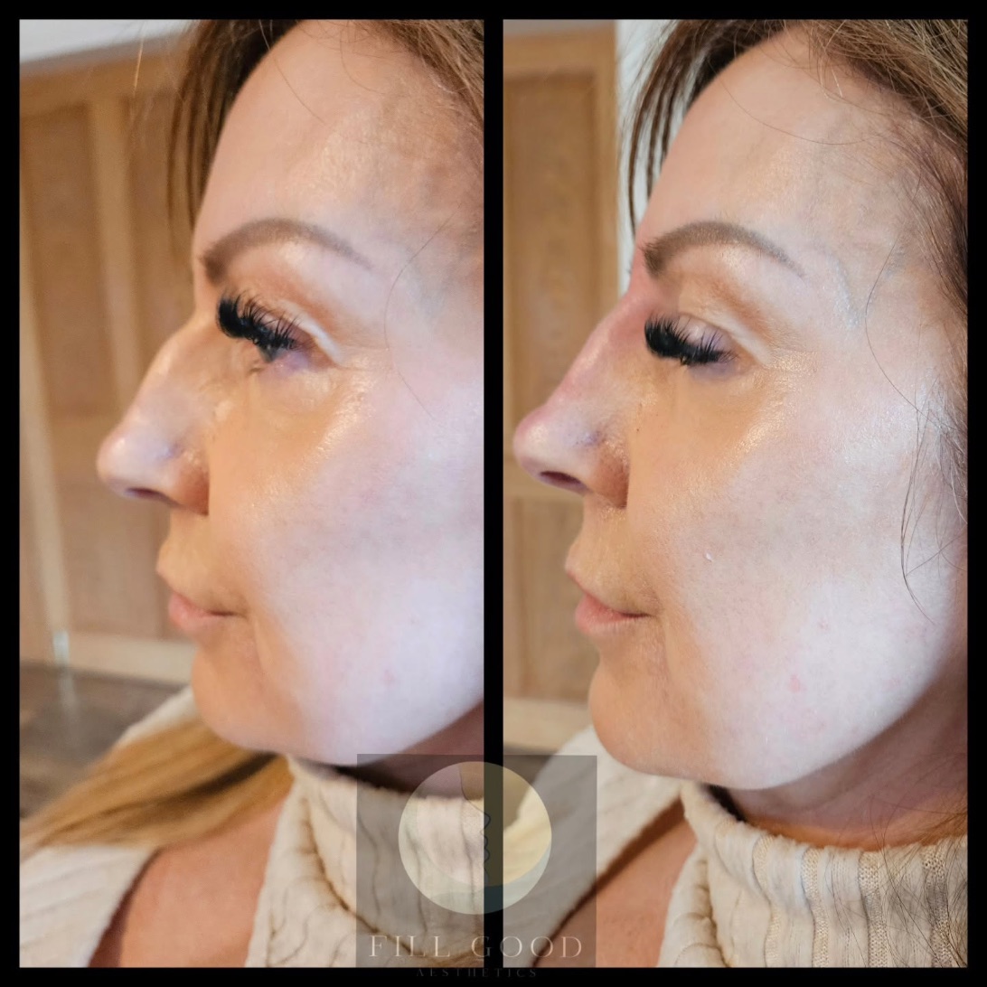Before and after non-surgical nose reshaping: the face in three-quarter view, before on the left and after on the right.