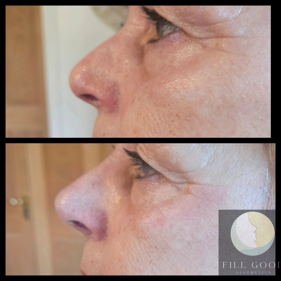 Before and after non-surgical nose reshaping: the nose and under-eye area in side profile, before above and after below.