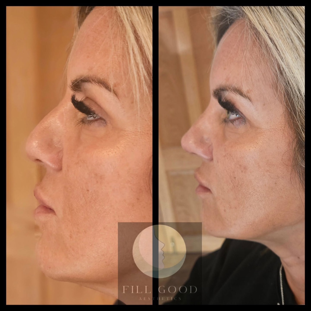 Before and after non-surgical nose reshaping: the face in three-quarter view from slightly below, before on the left and after on the right.