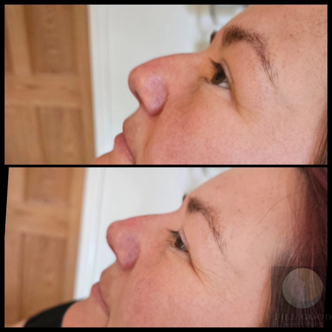 Before and after non-surgical nose reshaping: the nose in side profile from slightly below, before above and after below.