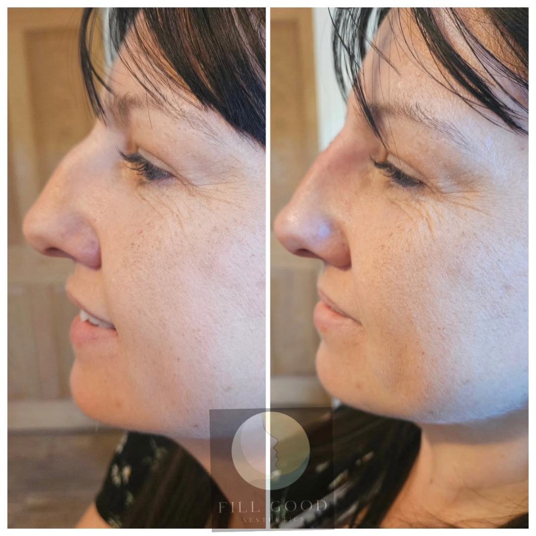 Before and after non-surgical nose reshaping: the face in side profile, before on the left and after on the right.