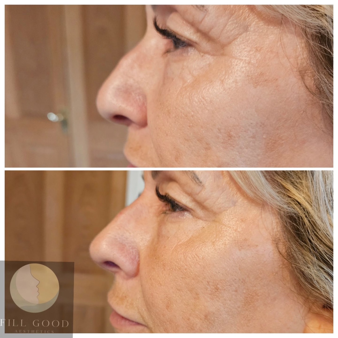 Before and after non-surgical nose reshaping: the nose in side profile, before above and after below.