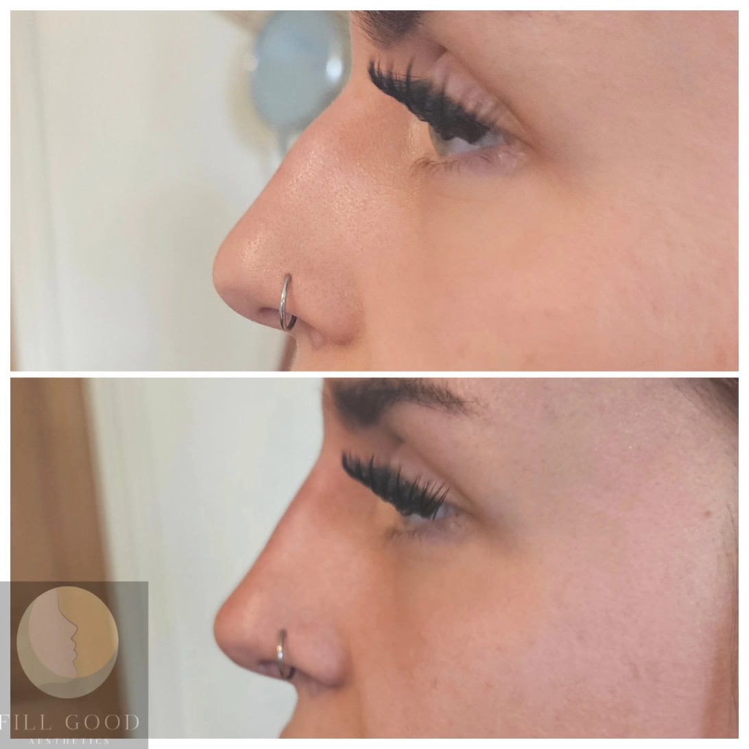 Before and after non-surgical nose reshaping: the nose in side profile, before above and after below.