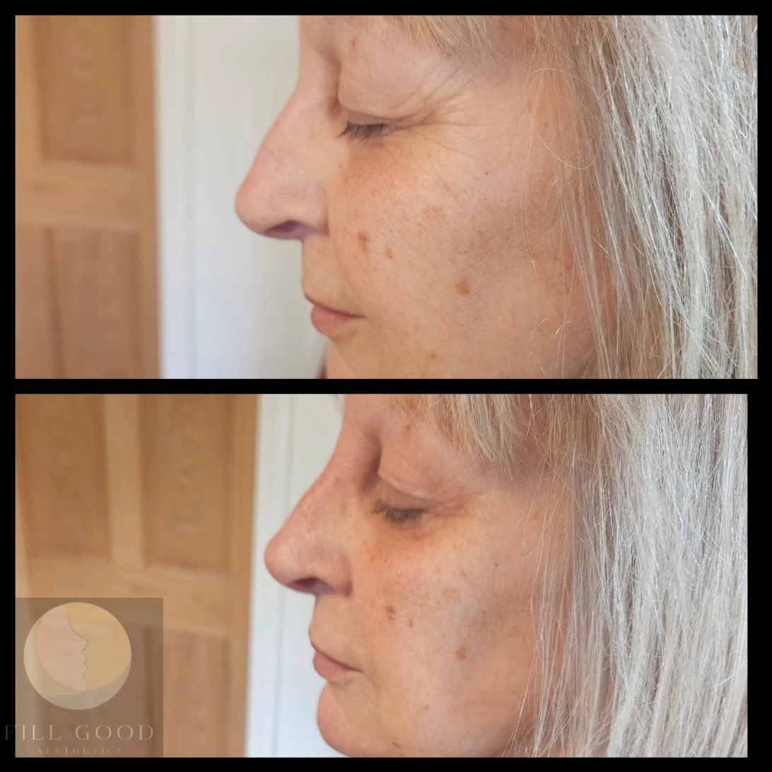 Before and after non-surgical nose reshaping: the nose and face in side profile, before above and after below.