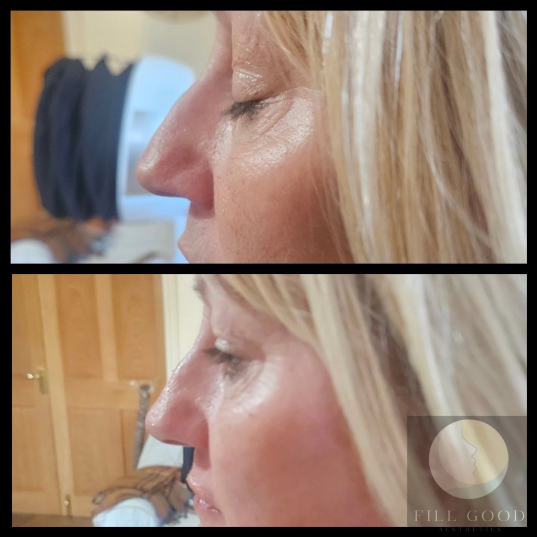 Before and after non-surgical nose reshaping: the nose in side profile, before above and after below.