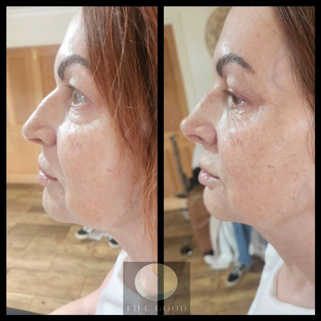 Before and after non-surgical nose reshaping: the face in side profile, before on the left and after on the right.