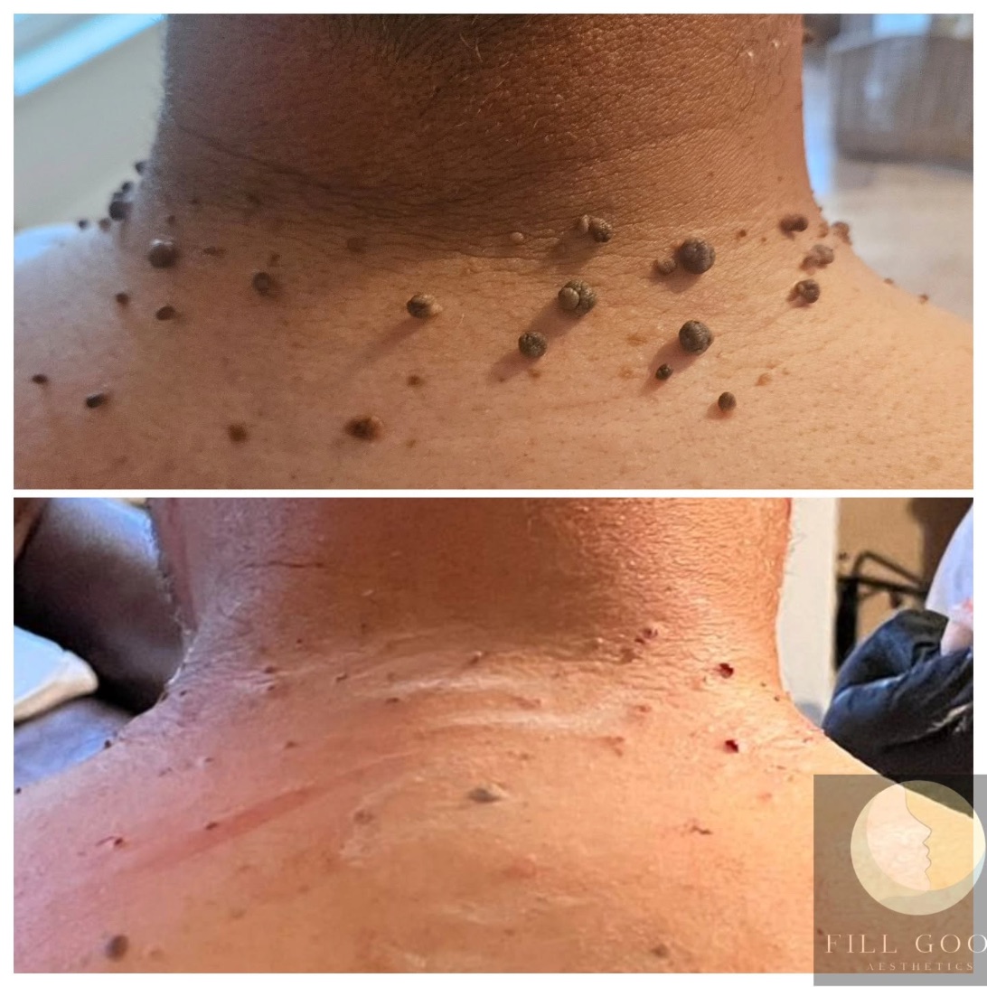 Before and after skin tag removal: the back of the neck, before above and after below. Before, many small skin tags; after, small red marks where they were removed.