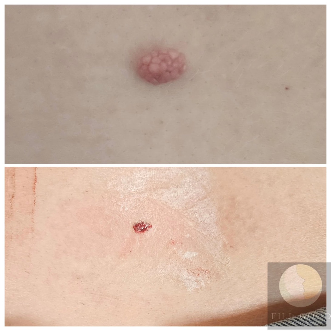 Before and after skin tag and lesion removal: a single raised lesion on the skin, before above and after below. After, the same area with a small fresh wound where it was removed.