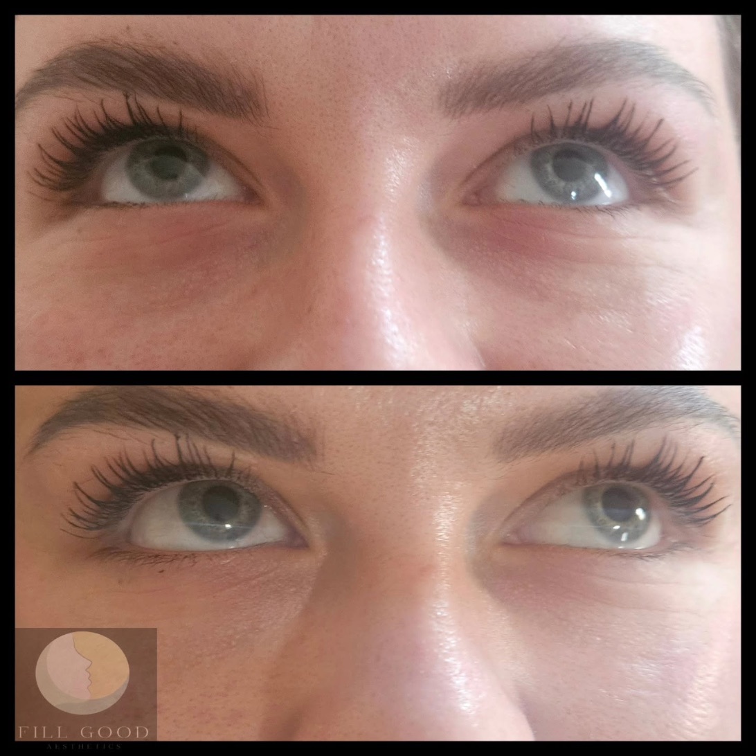 Before and after tear trough filler: both eyes and the under-eye area front on, before above and after below.