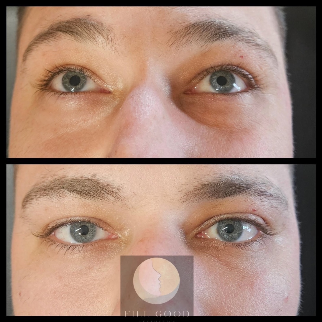 Before and after tear trough filler: both eyes front on, before above and after below.